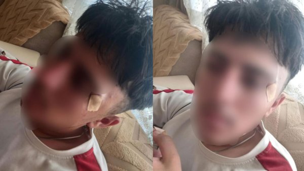 Afyonkarahisar'da öğretmenin kafa attığı çocuğun burnu kırıldı: Soruşturma başlatıldı